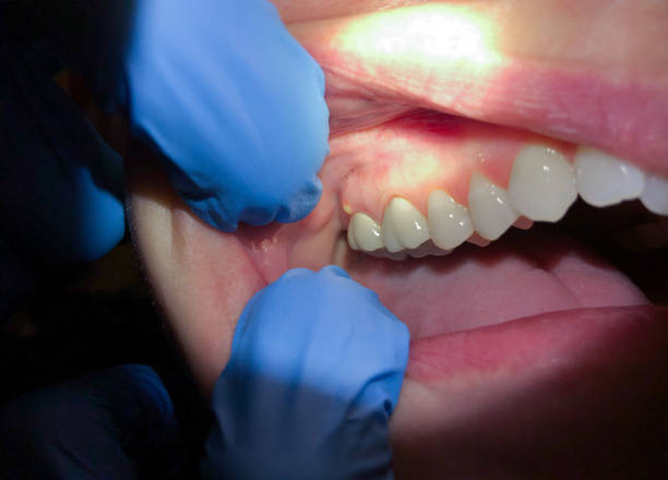 Best Dentist for Tooth Abscess  in Frisco City, AL